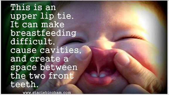 How Does Upper Lip Tie Affect Breastfeeding?