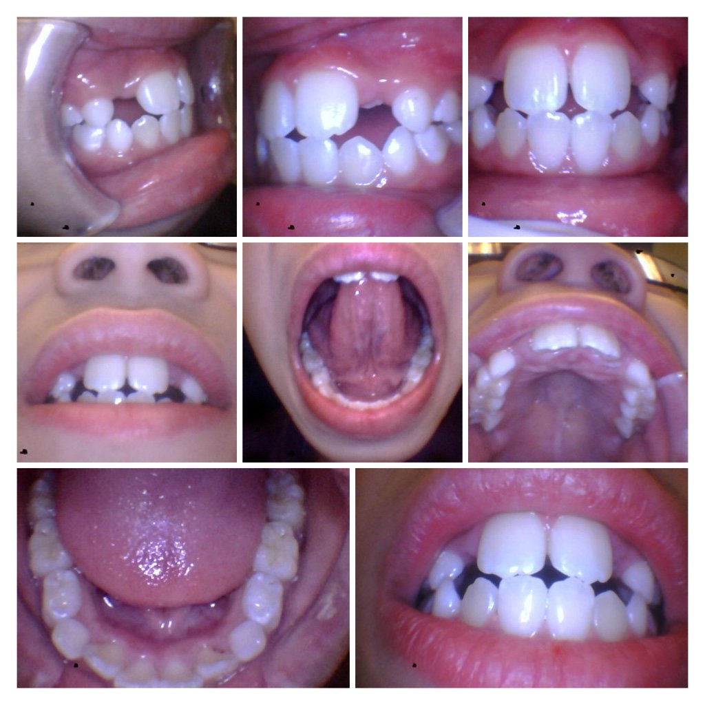 Patient Photo of teeth