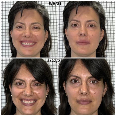 TMJ Treatment Before and After