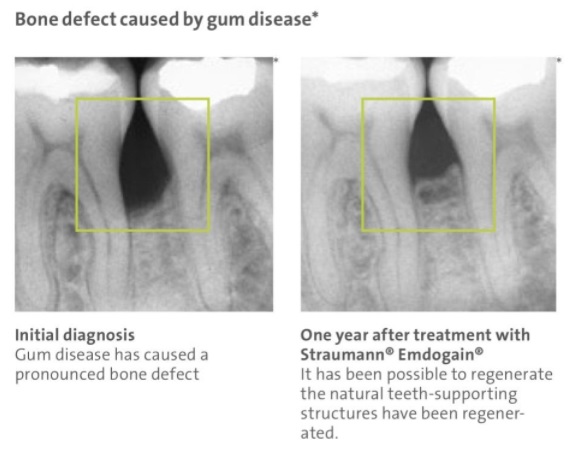 emdogain