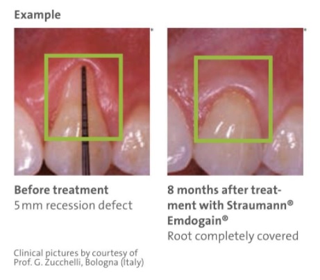 emdogain