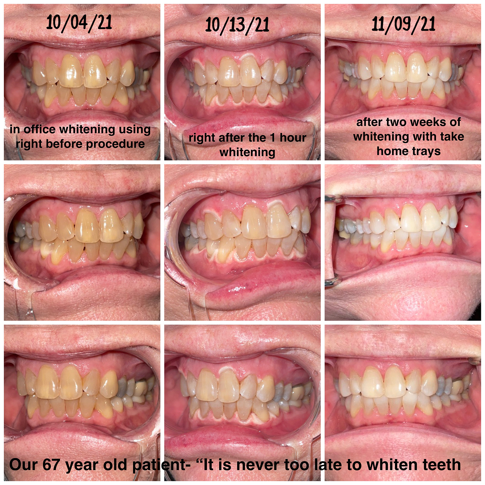 example KöR® whitening