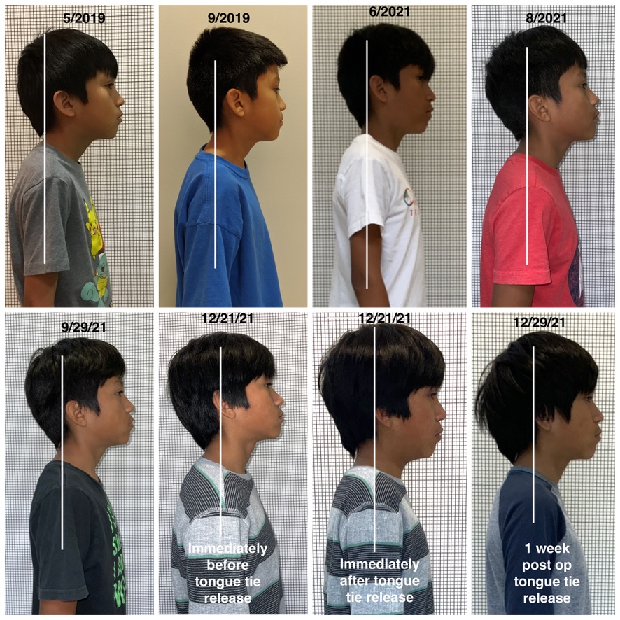 a series of photos of a young boy's posture improvement from the side profile