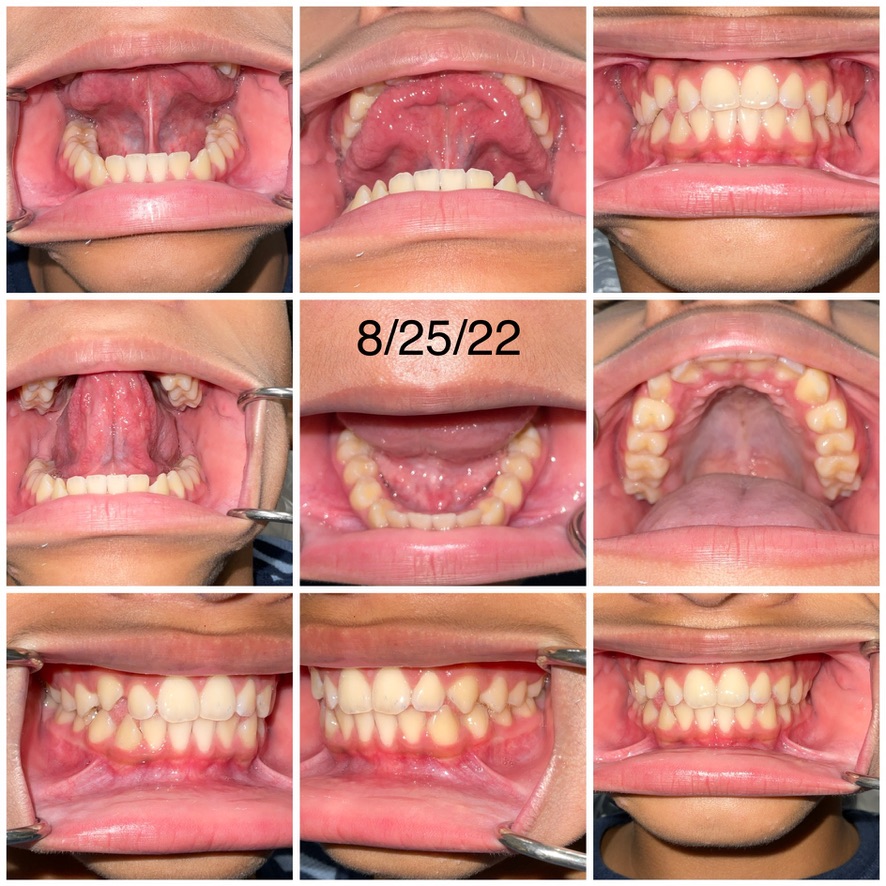 a collage of photos of a young boy's teeth
