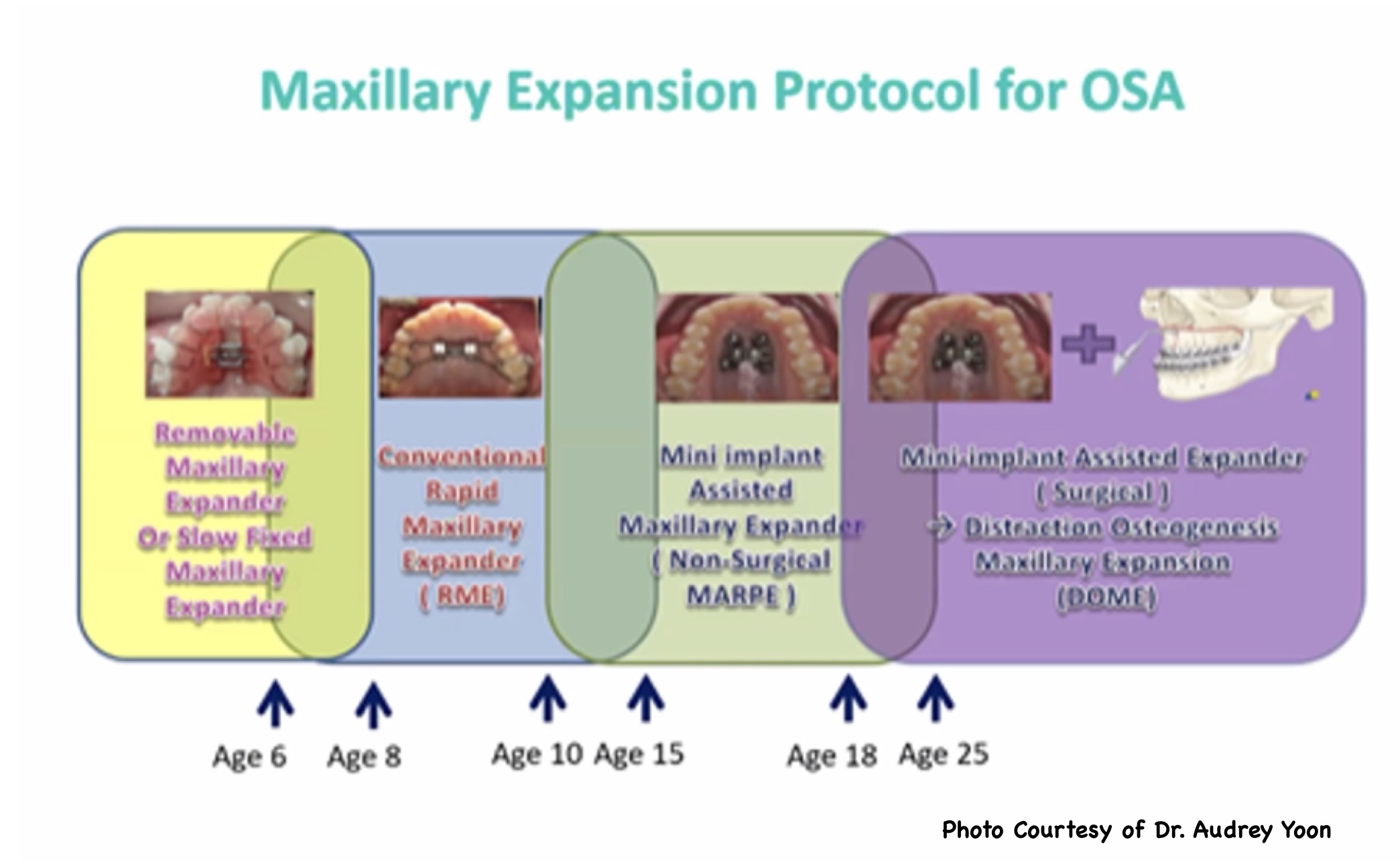 Maxillary Expansion Protocol for OSA