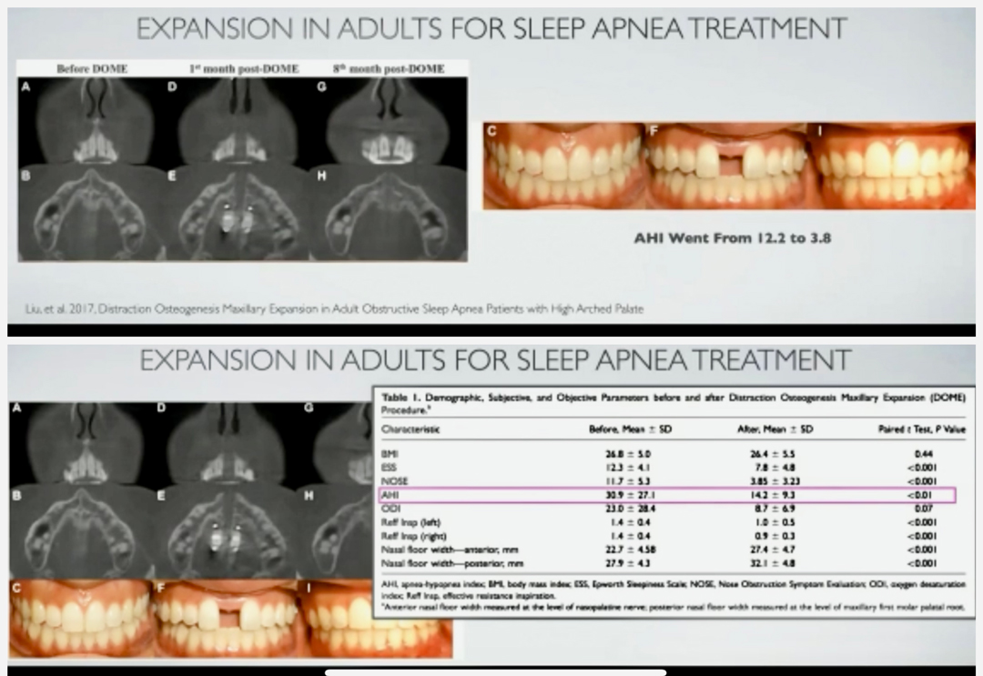 slides showing expansion in adults for sleep apnea treatment