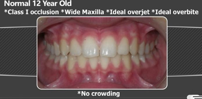 normal 12 year old, Class I occlusion, wide maxilla, ideal overjet, ideal overbite