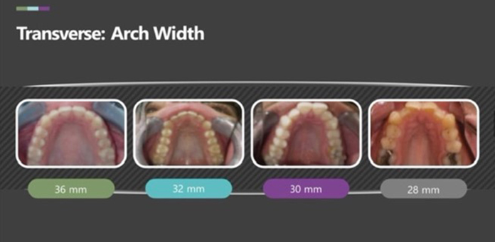 Tranverse Arch Width