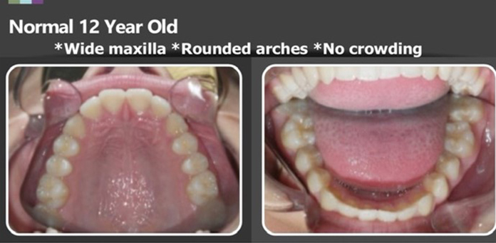 normal 12 year old, wide maxilla, rounded arches, no crowding