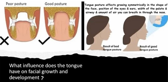 diagram showing influence of tongue on facial growth and development
