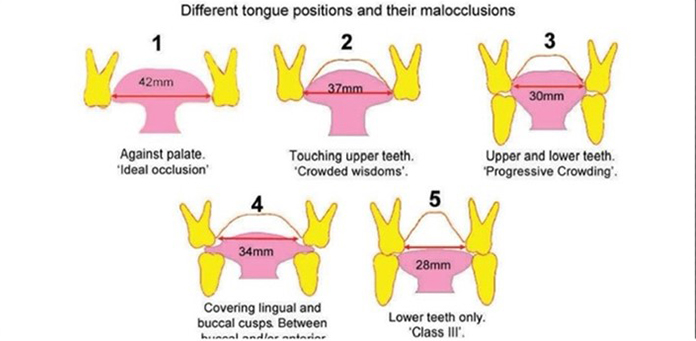 different tongue positions and their malocclusions