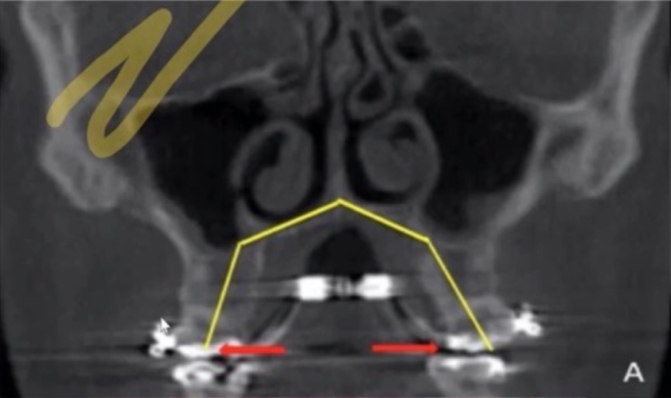 x-ray showing dental expansion through fixed expanders