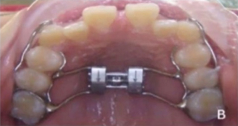 close up of teeth showing dental expansion through fixed expanders
