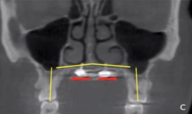 x-ray showing skeletal expansion assisted by miniscrews