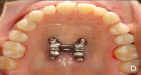 close up of teeth showing showing skeletal expansion assisted by miniscrews