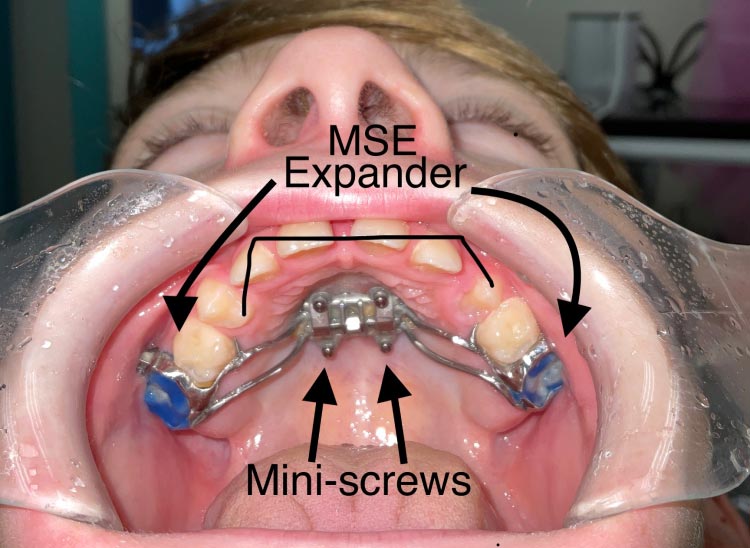 mouth close up of MSE MARPE