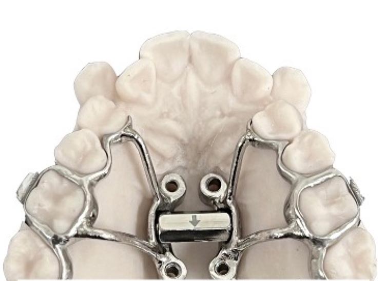 diagram showing MARPE in smaller mouths