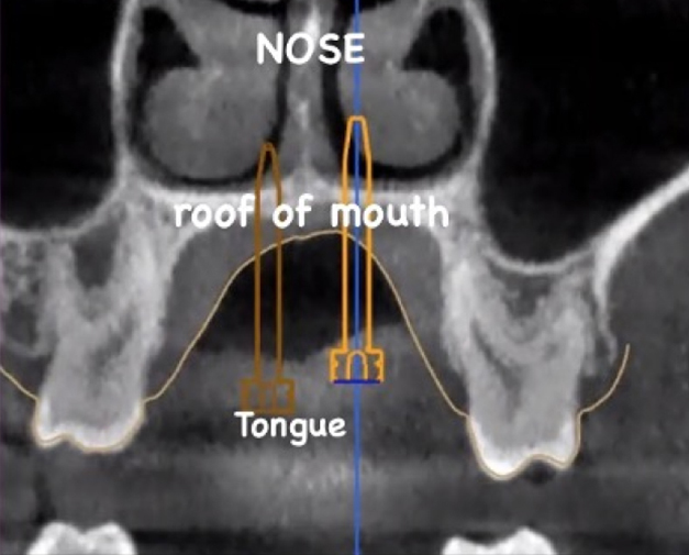 xray showing screw placement