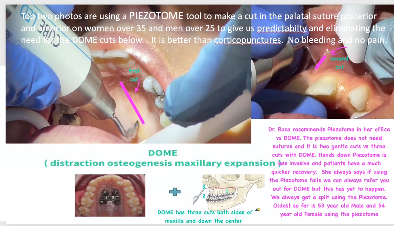 Diagram with Piezotome CUBE being used