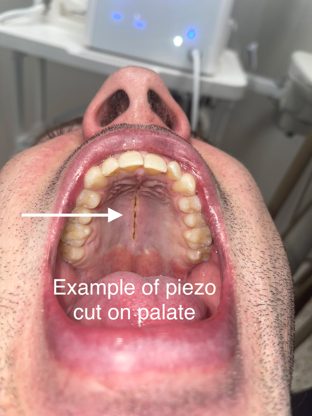 example of piezo cut on palate, incision across the top of the palate
