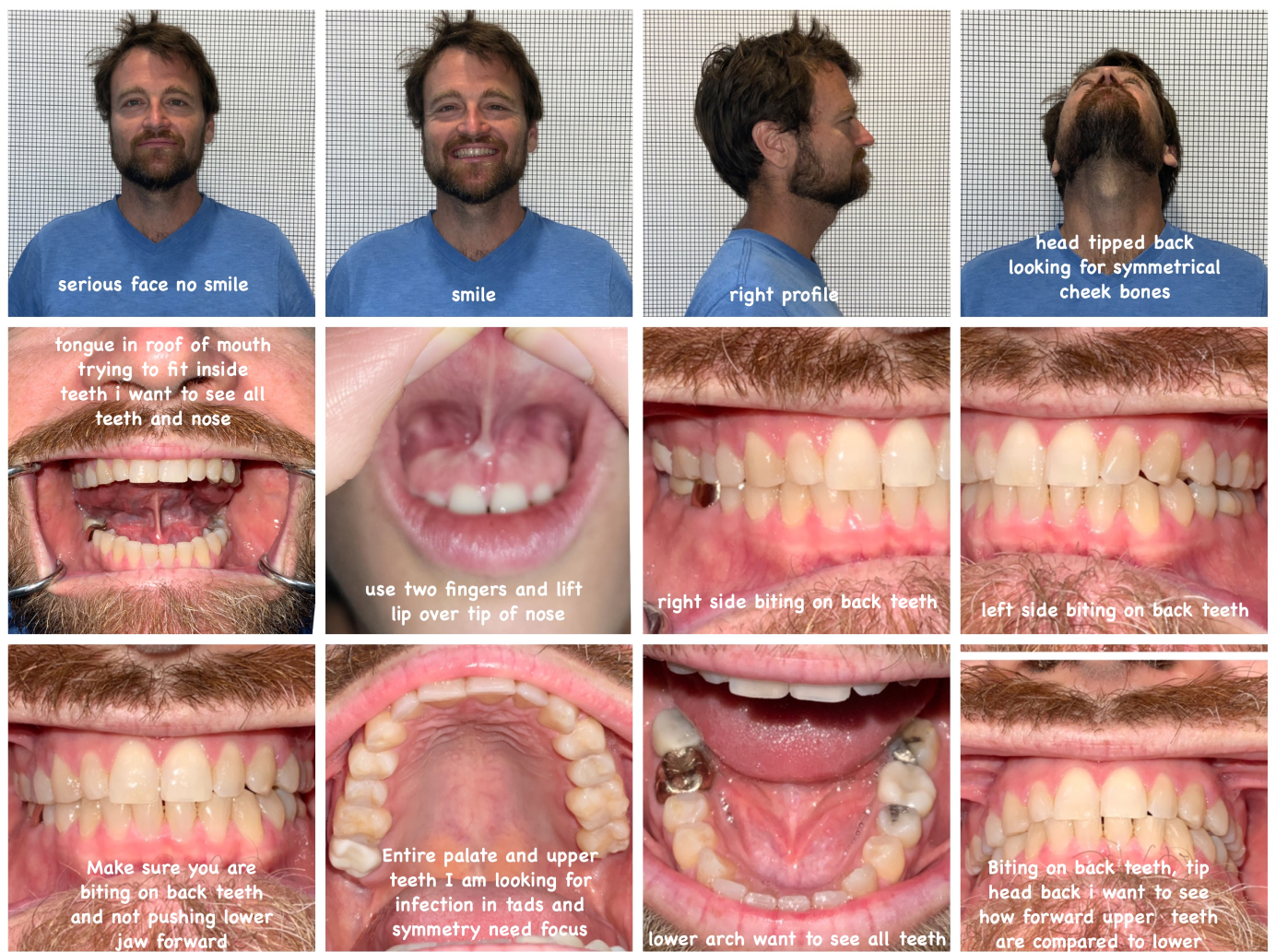 series of male adult's teeth progress photos