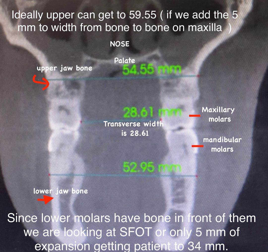 xrays showing how much expansion can be done