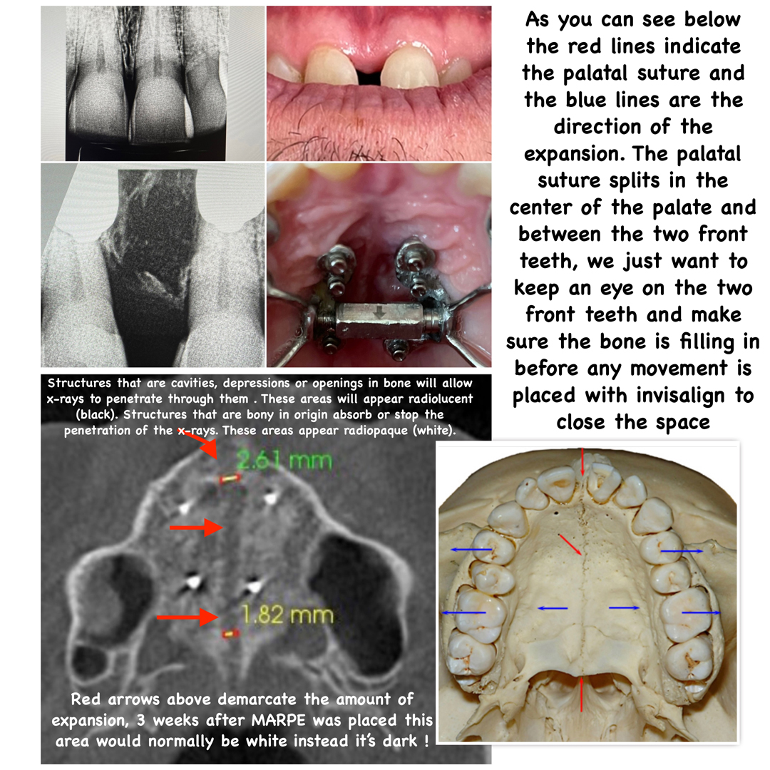 combination graphic of xrays and teeth progress
