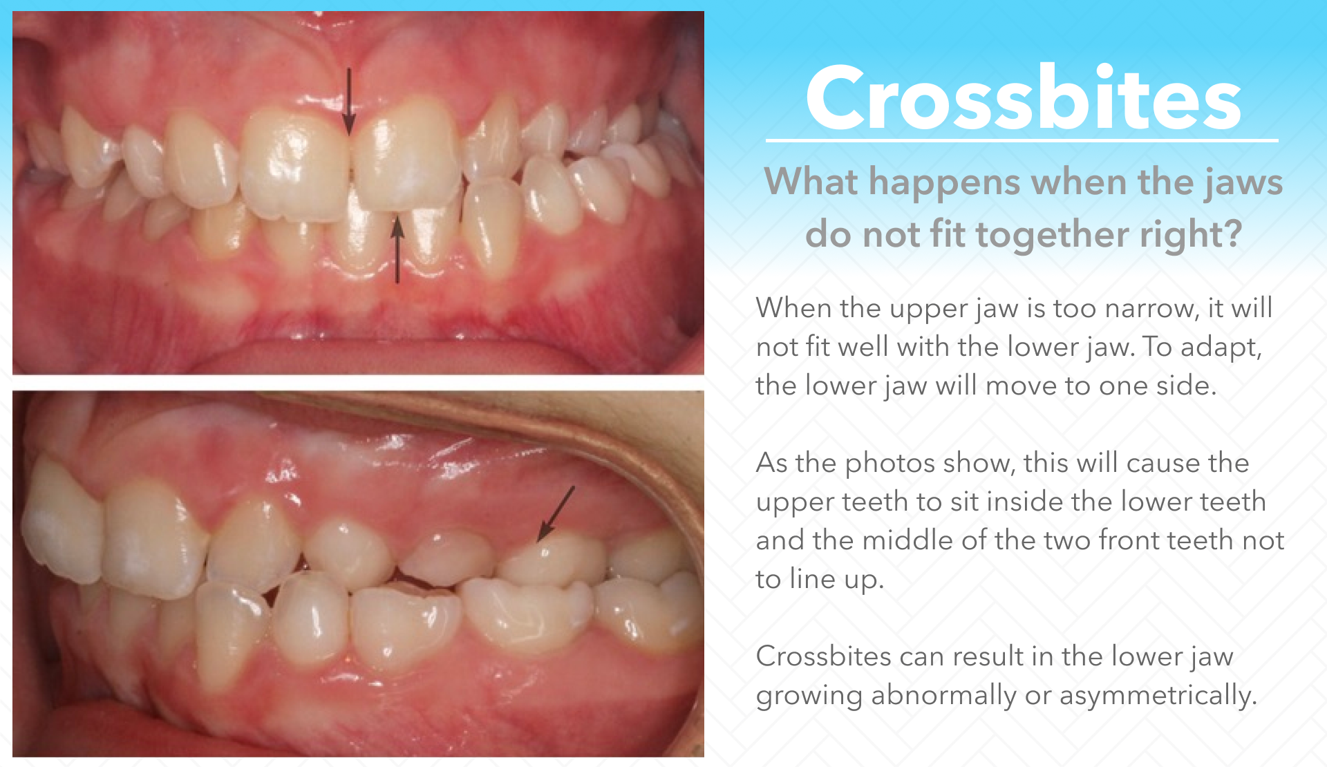 crossbite on one side