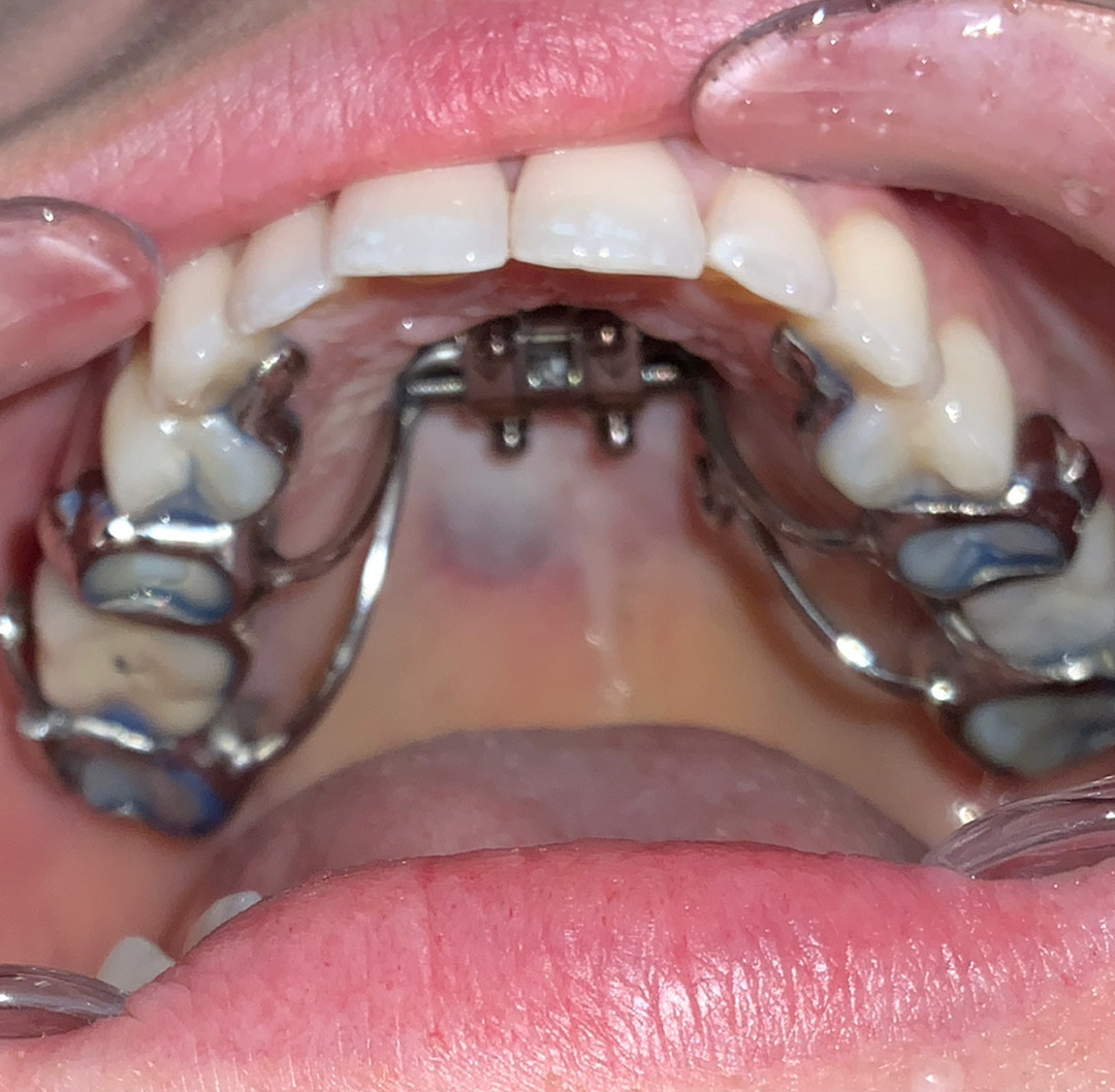 a close up of a person's teeth showing the start of expansion with MSE