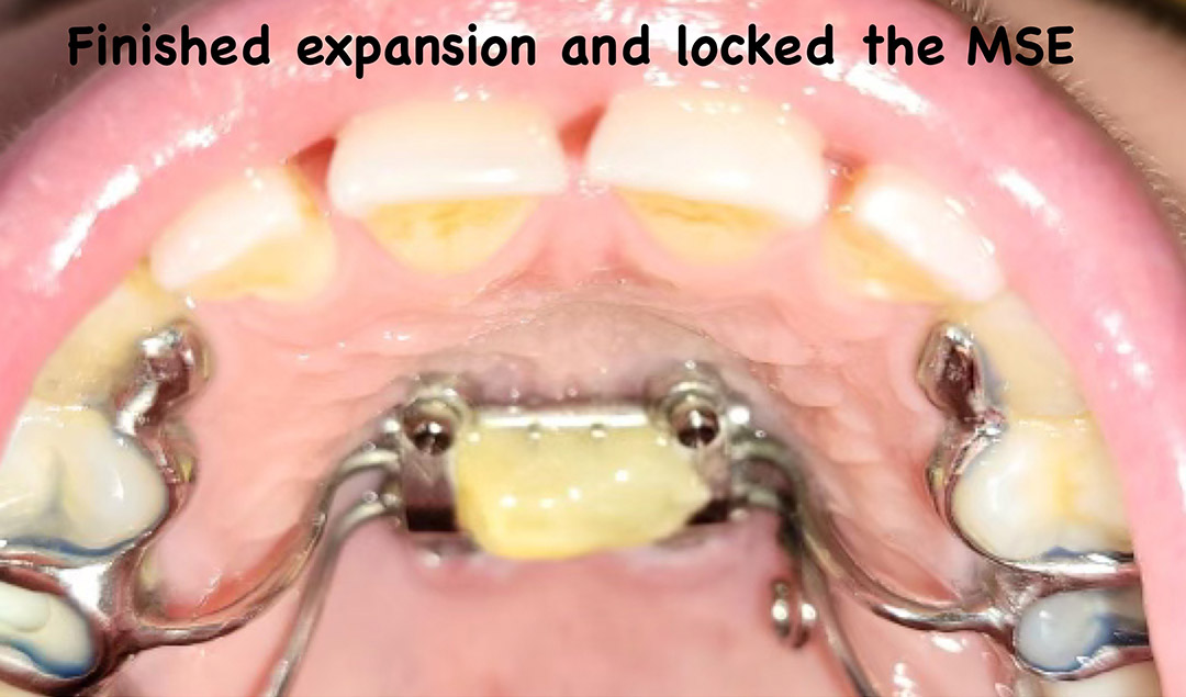 finished expansion snapshot of the mouth