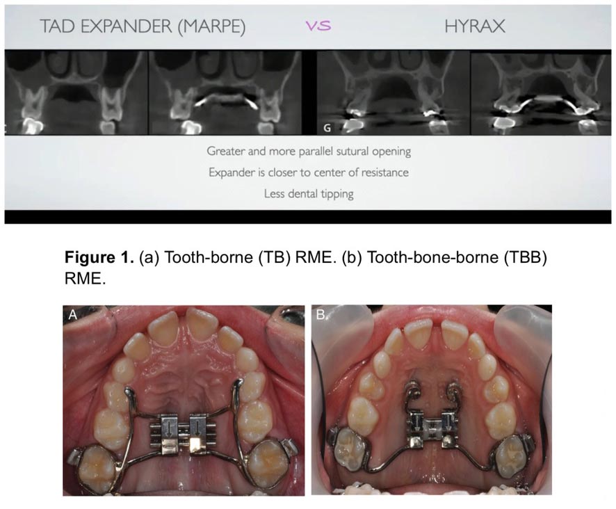 difference between a regular fixed expander and MARPE