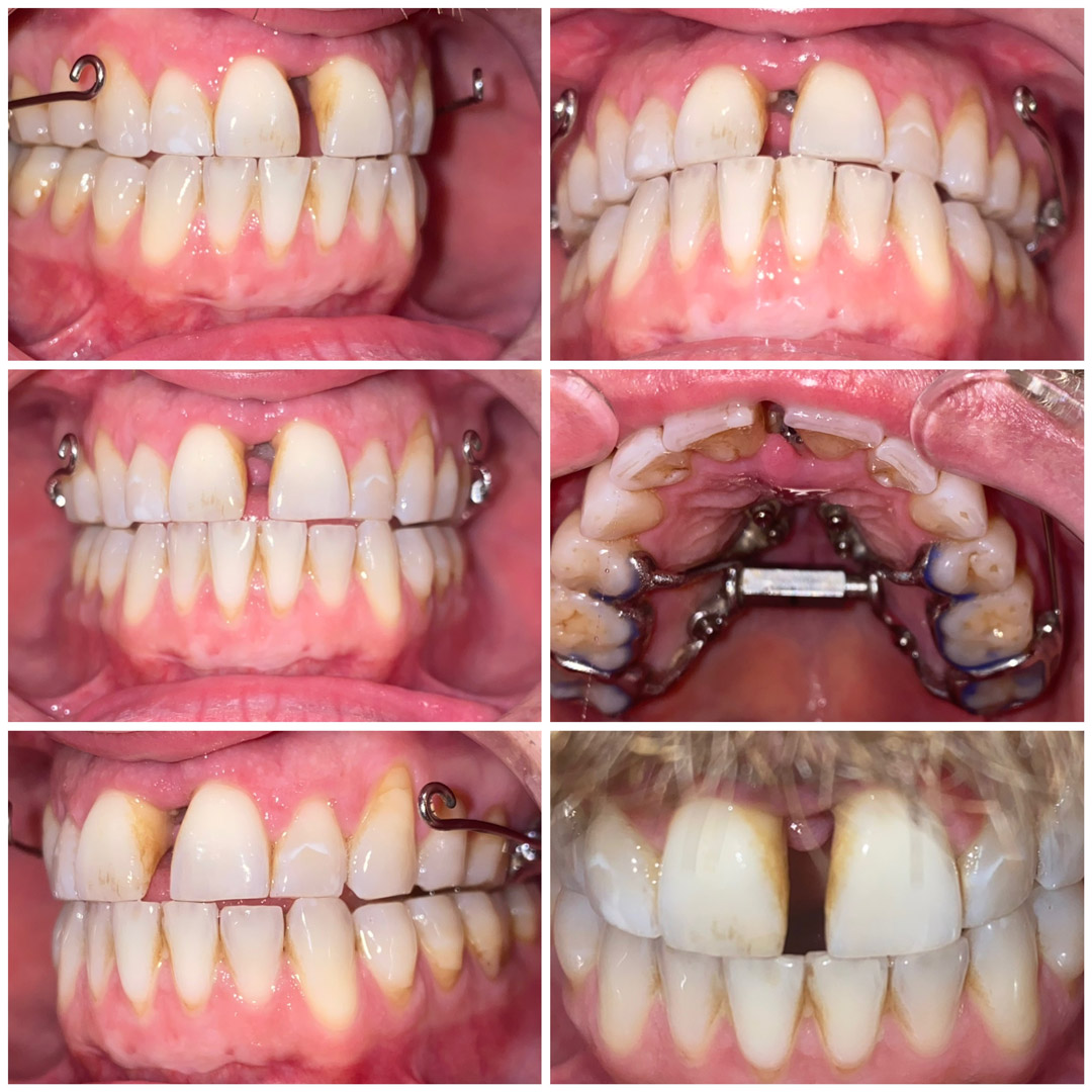 teeth progress 3 weeks after placement