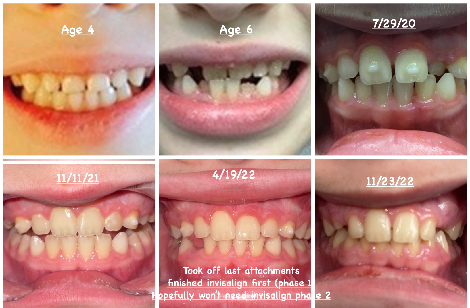 6 Reasons to Consider Invisalign First for Your Child