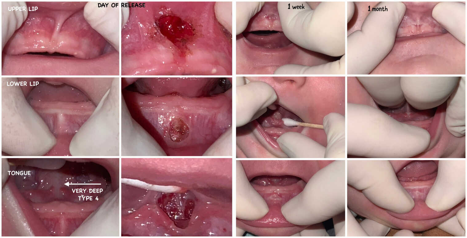 tongue tie example