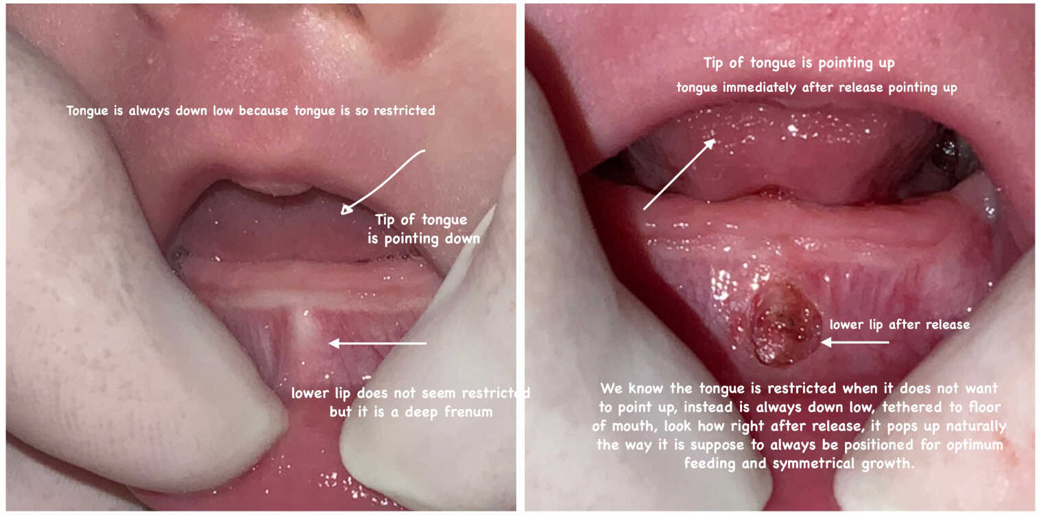 tongue tie example